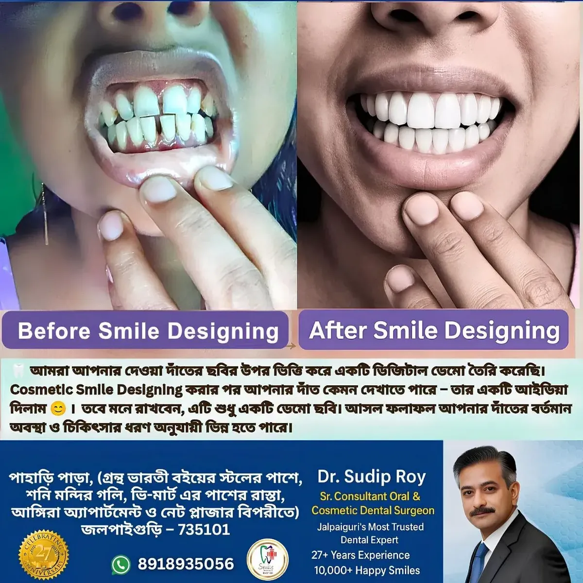 Fixed teeth in one day Jalpaiguri – smile correction