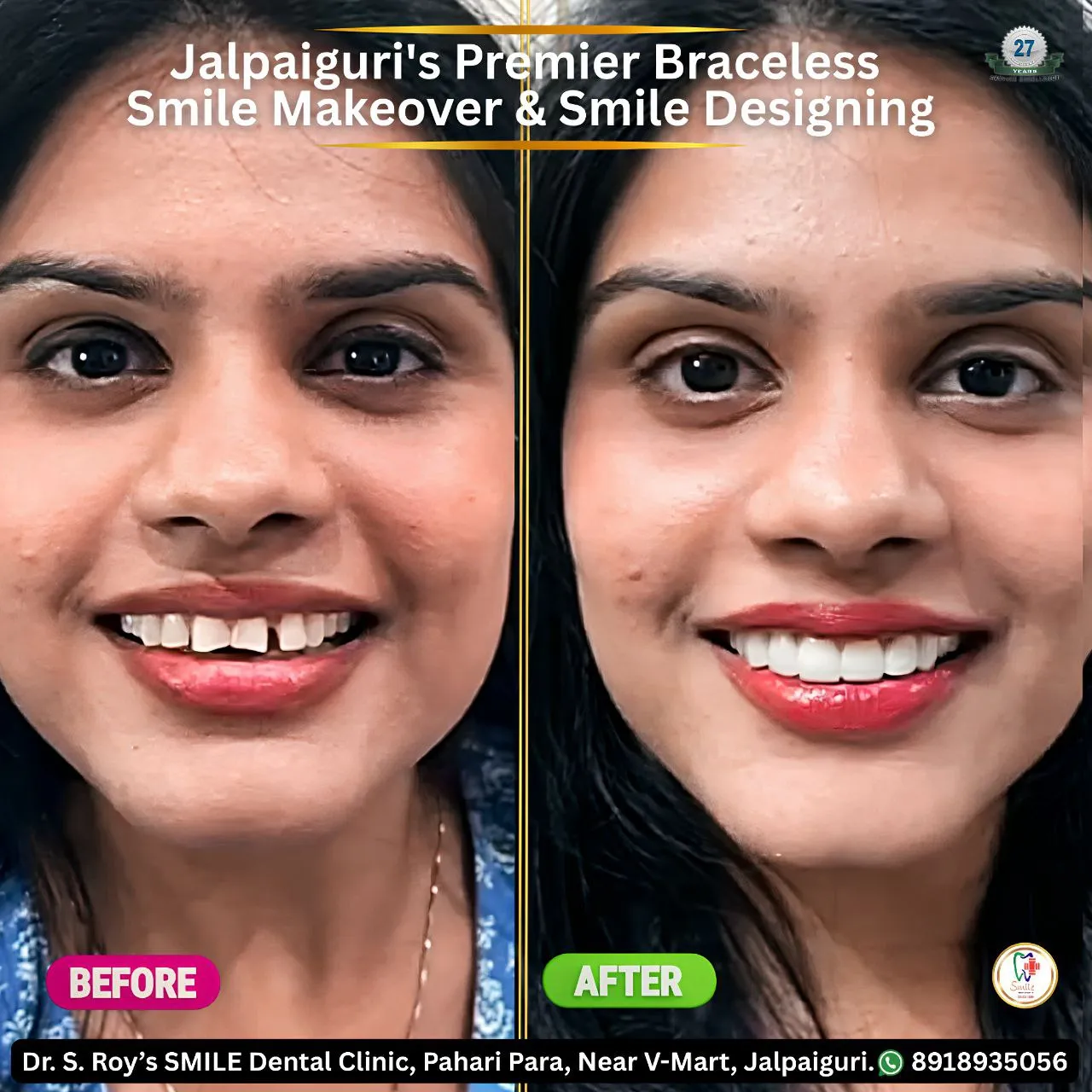 Digital Smile Design Jalpaiguri – cosmetic dentistry result
