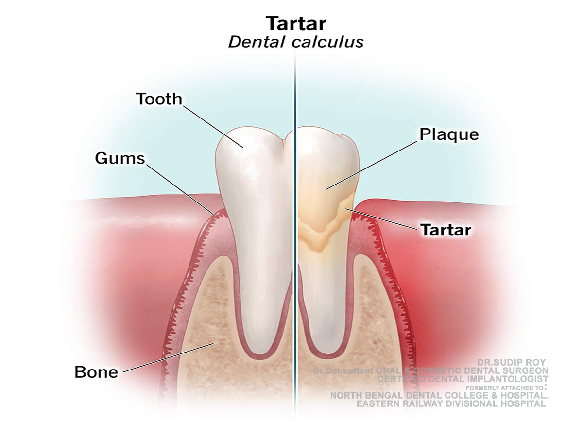 Dental plaque removal guidance by Dr. Sudip Roy in Jalpaiguri